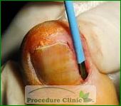 Ingrown Toenail